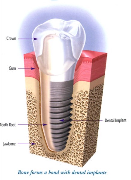 Dental implant diagram